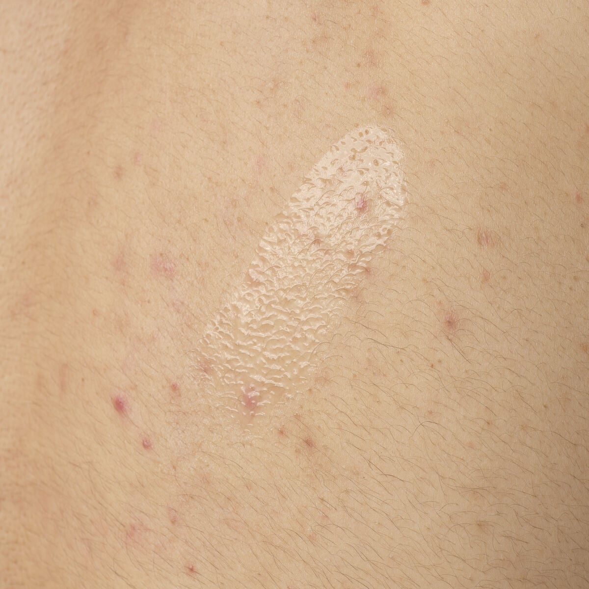 salicylic-acid-0-5-body-serum-x6 ORD-salicylic-acid-05-body-240ml-application.jpg