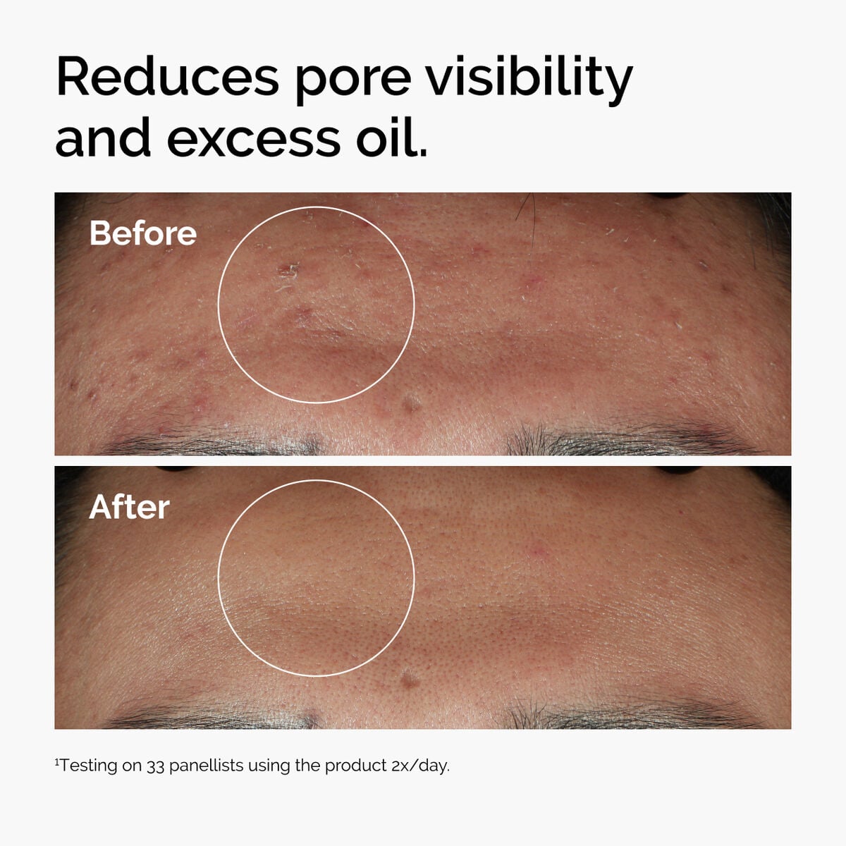 niacinamide-10-zinc-1-j2 ord-niacinamide-zinc-blemish-serum-before-after-pores.jpg