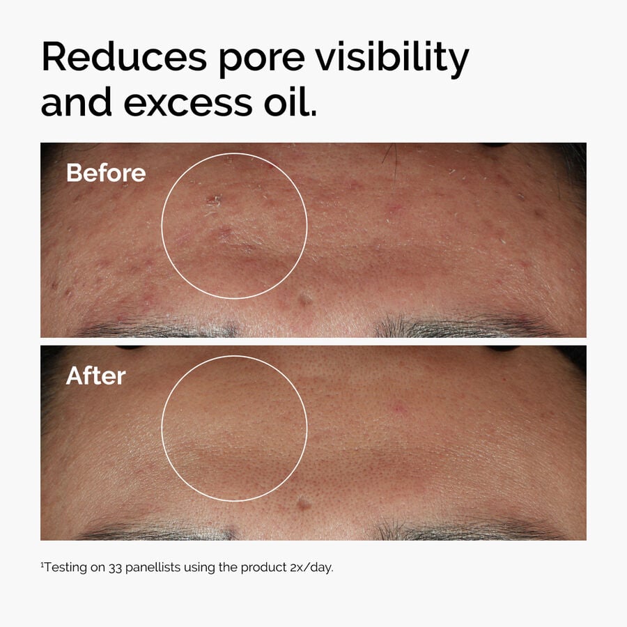 niacinamide-10-zinc-1-j2 ord-niacinamide-zinc-blemish-serum-before-after-pores.jpg