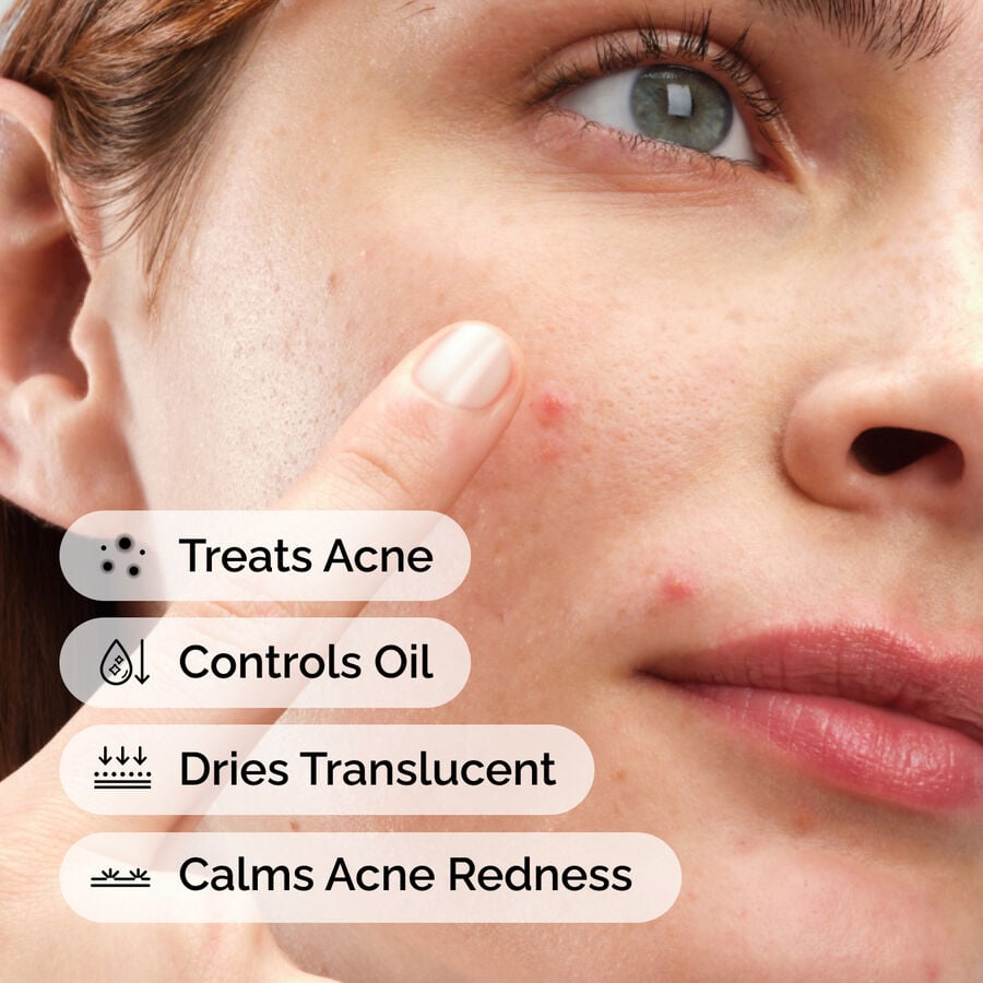 sulfur-10-powder-to-cream-concentrate-p5 ord-sulfur-10pct-powder-to-cream-concentrate-model-application-with-benefits-acne.jpg