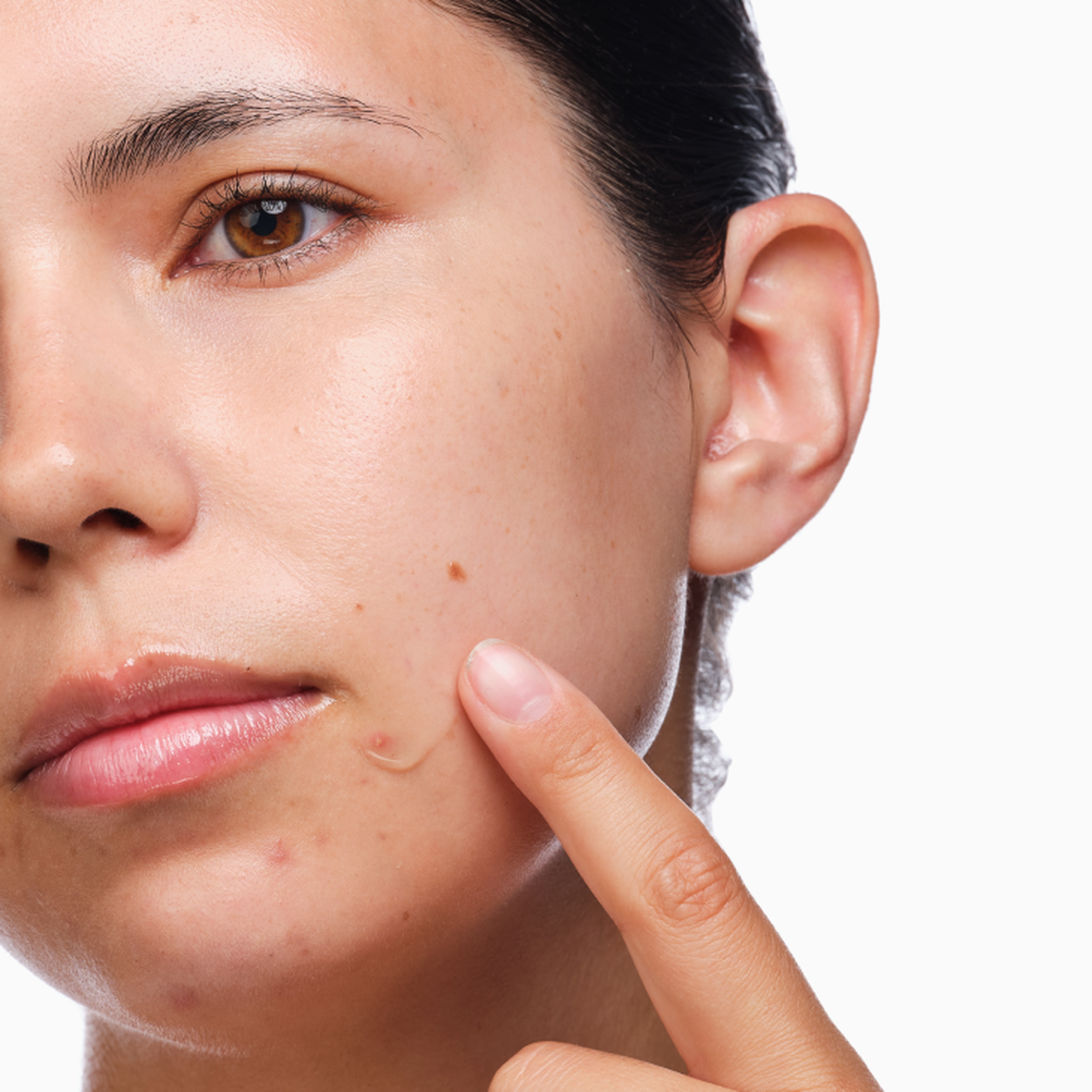 the-acne-set-q7 rdn-the-acne-set-application.png